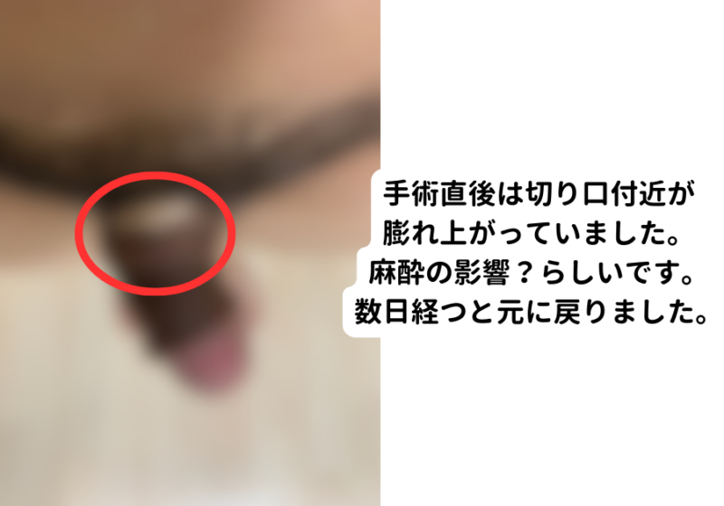 手術直後の写真_モザイクあり