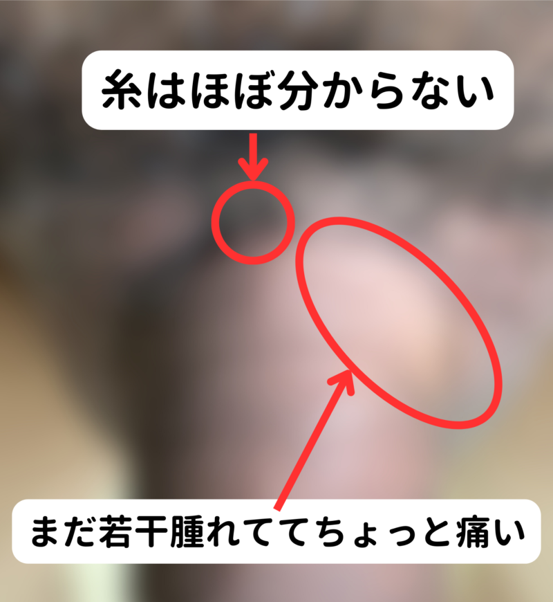 長茎手術_1週間後_モザイクあり